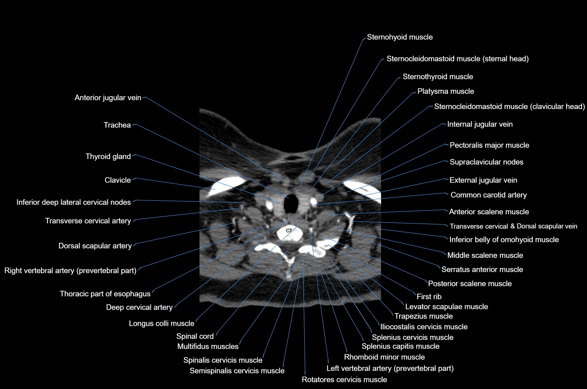 CT Neck axial cross sectional anatomy radiology image-img-00001-00051.webp